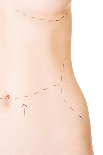 Liposuction